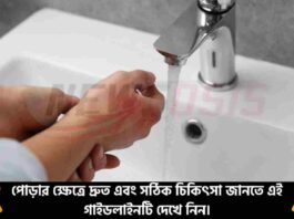 Know How to Give First Aid for Burns at Home Safely