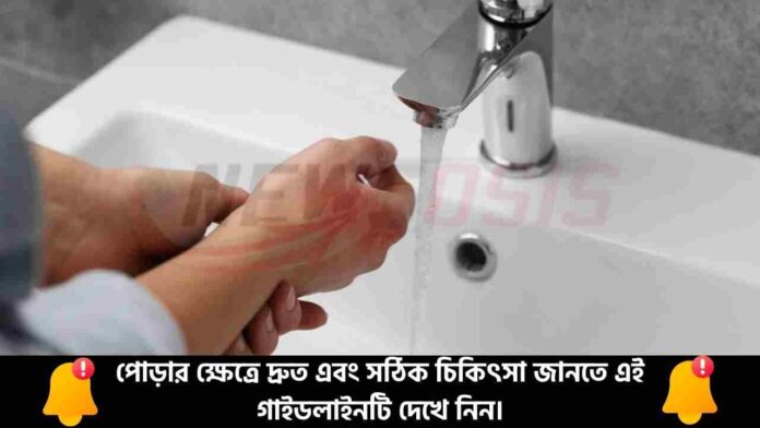 Know How to Give First Aid for Burns at Home Safely